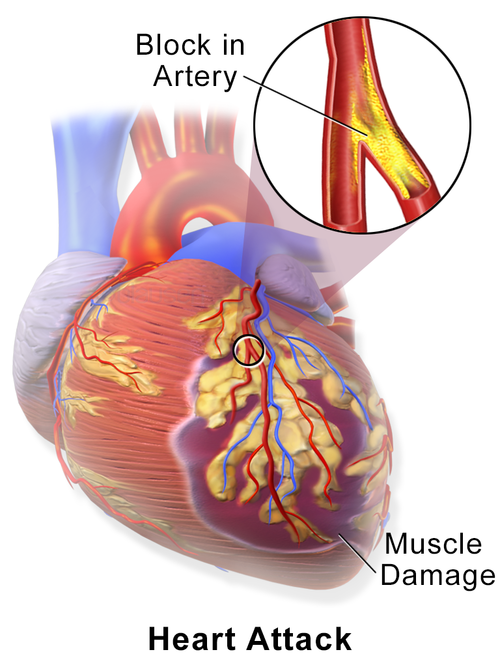 myocardial infarction